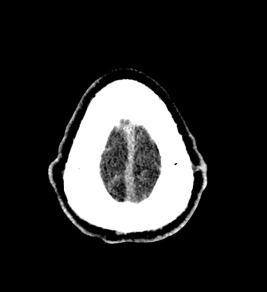 File:Arachnoid cyst of the ambient cistern (Radiopaedia 81301-94986 Axial non-contrast 69).jpg