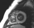 Arrhythmogenic right ventricular cardiomyopathy (Radiopaedia 69431-79307 Short axis cine 30).jpg