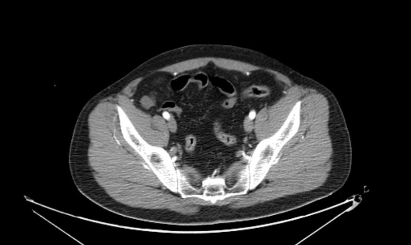 File:Arterial occlusive mesenteric ischemia (Radiopaedia 84641-100060 A 108).jpg