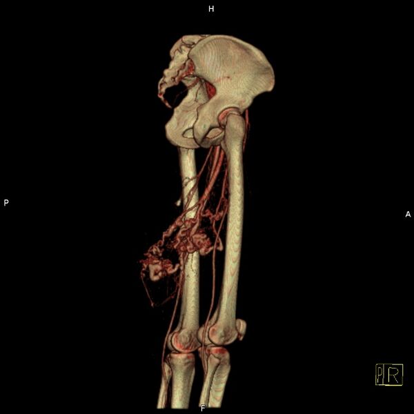 File:Arteriovenous malformation of the thigh (Radiopaedia 14948-14883 C 5).jpg