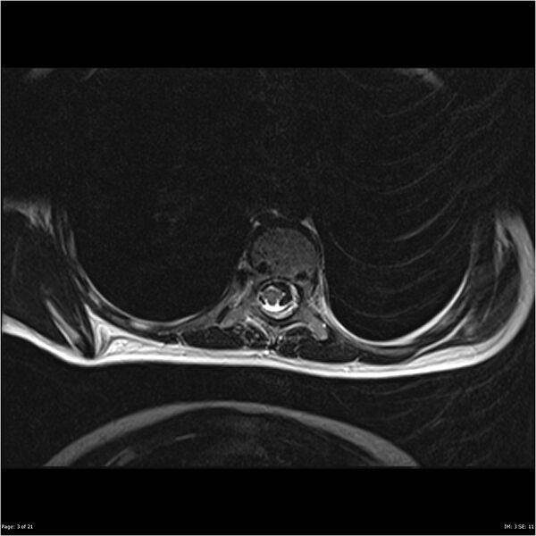 File:Arthrogryposis and muscle atrophy (Radiopaedia 24081-24314 C 3).jpg