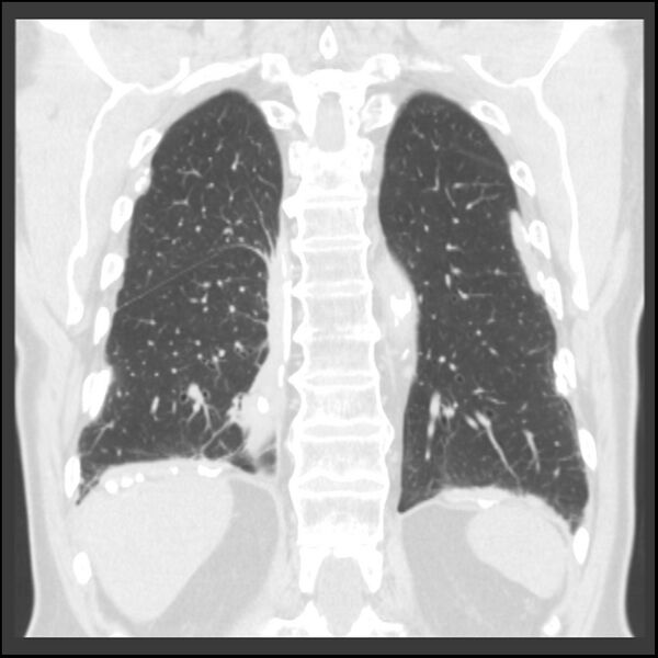 File:Asbestos-related pleural plaques (Radiopaedia 39069-41255 Coronal lung window 21).jpg