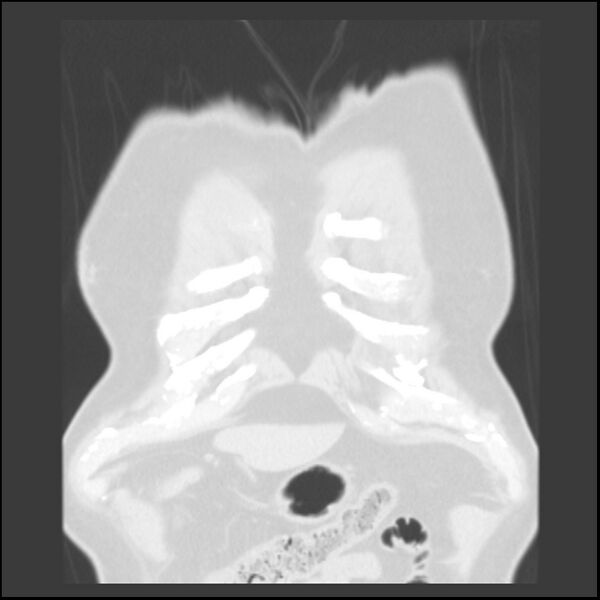 File:Asbestos-related pleural plaques (Radiopaedia 39069-41255 Coronal lung window 84).jpg