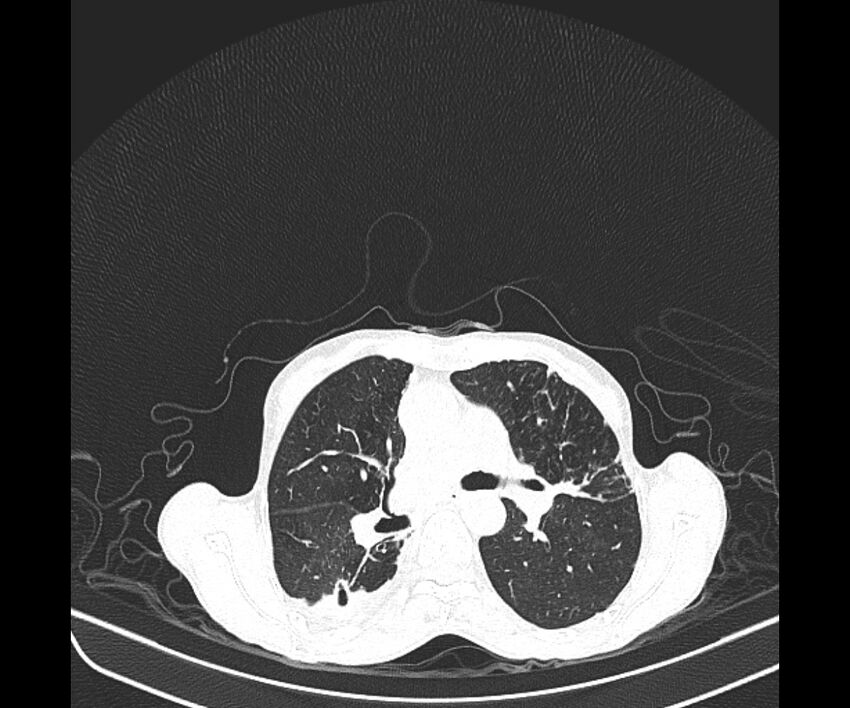 Aspergillomas (Radiopaedia 66779-76110 Axial lung window 22).jpg