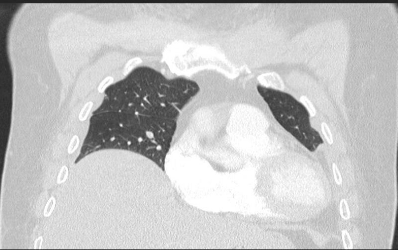 File:Aspirated tooth (Radiopaedia 28584-28844 Axial lung window 39).jpg