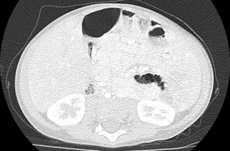 File:Asplenia syndrome (Radiopaedia 73083-83792 Axial lung window 100).jpg