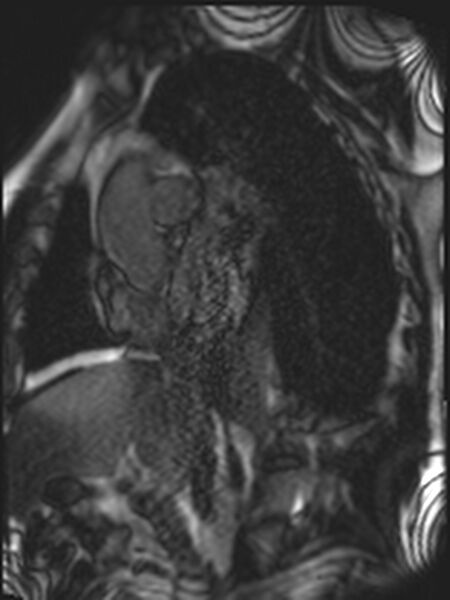 File:Asymmetric septal hypertrophic cardiomyopathy - systolic anterior motion of mitral leaflet (Radiopaedia 72795-83445 D 1).jpg