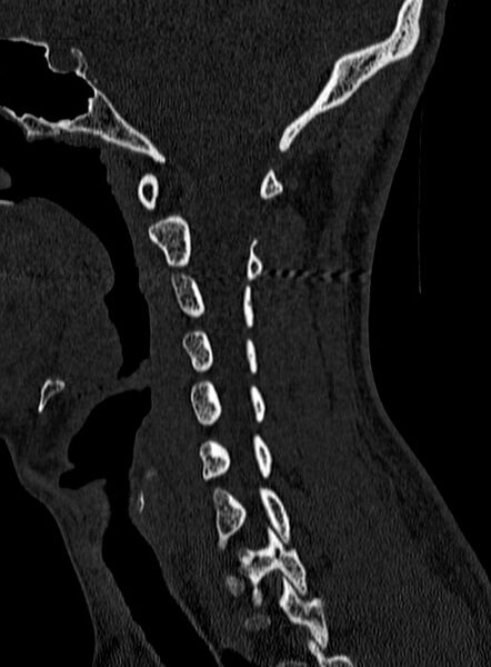 File:Atlantoaxial subluxation (Radiopaedia 44681-48450 Sagittal bone window 44).jpg