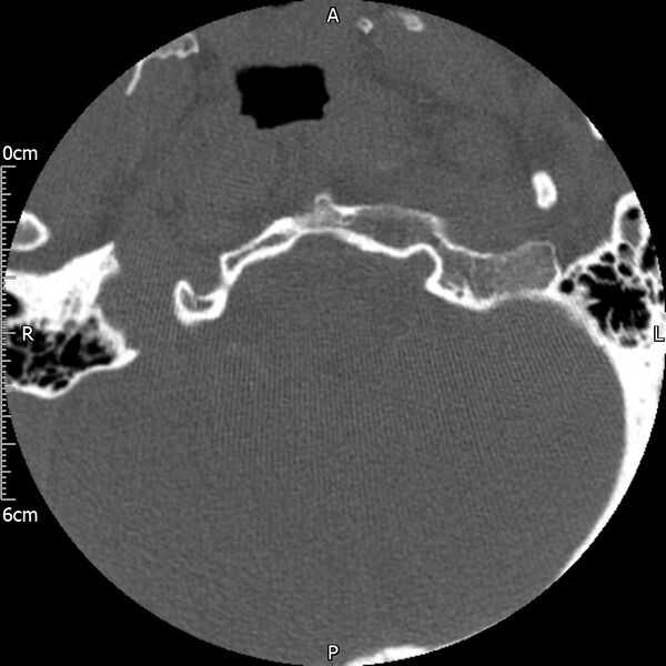 File:Atlas fracture with Currarino type A congenital defect (Radiopaedia 71747-82144 Axial bone window 6).jpg