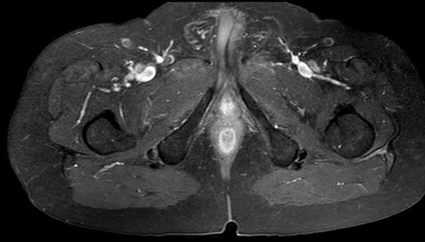 Atypical lipomatous tumor - thigh (Radiopaedia 68975-78734 Axial T1 C+ fat sat 83).jpg