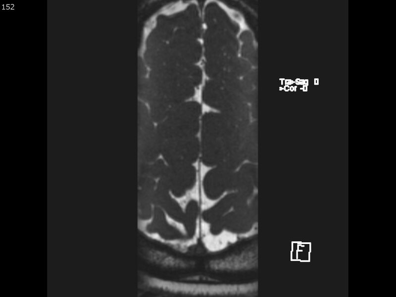 File:Atypical meningioma - intraosseous (Radiopaedia 64915-74572 Axial CISS 152).jpg