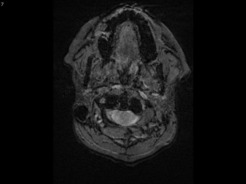 Atypical meningioma - intraosseous (Radiopaedia 64915-74572 Axial SWI 7).jpg