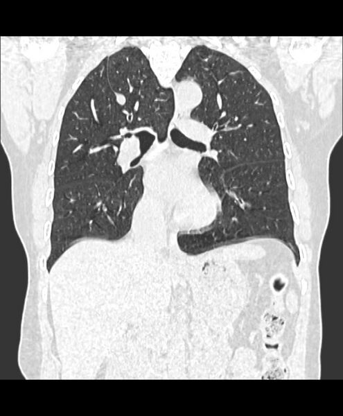 File:Azygos fissure and azygos lobe (Radiopaedia 41841-44832 Coronal lung window 9).jpg