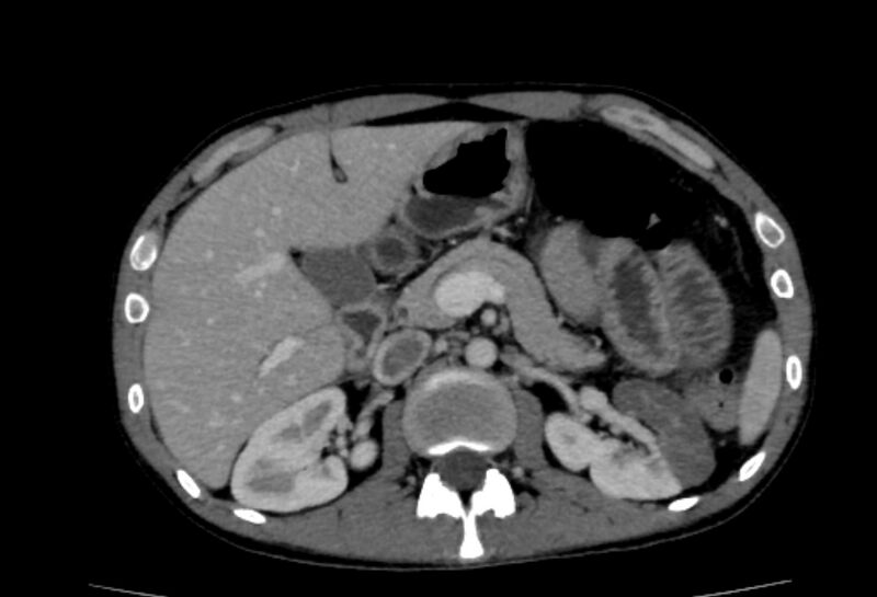 File:Behçet's disease- abdominal vasculitis (Radiopaedia 55955-62570 A 24).jpg