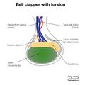 Bell clapper deformity (diagram) (Radiopaedia 86124-102079 F 1).jpeg