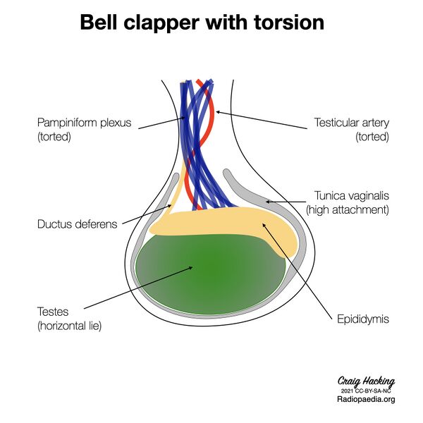 File:Bell clapper deformity (diagram) (Radiopaedia 86124-102079 F 1).jpeg