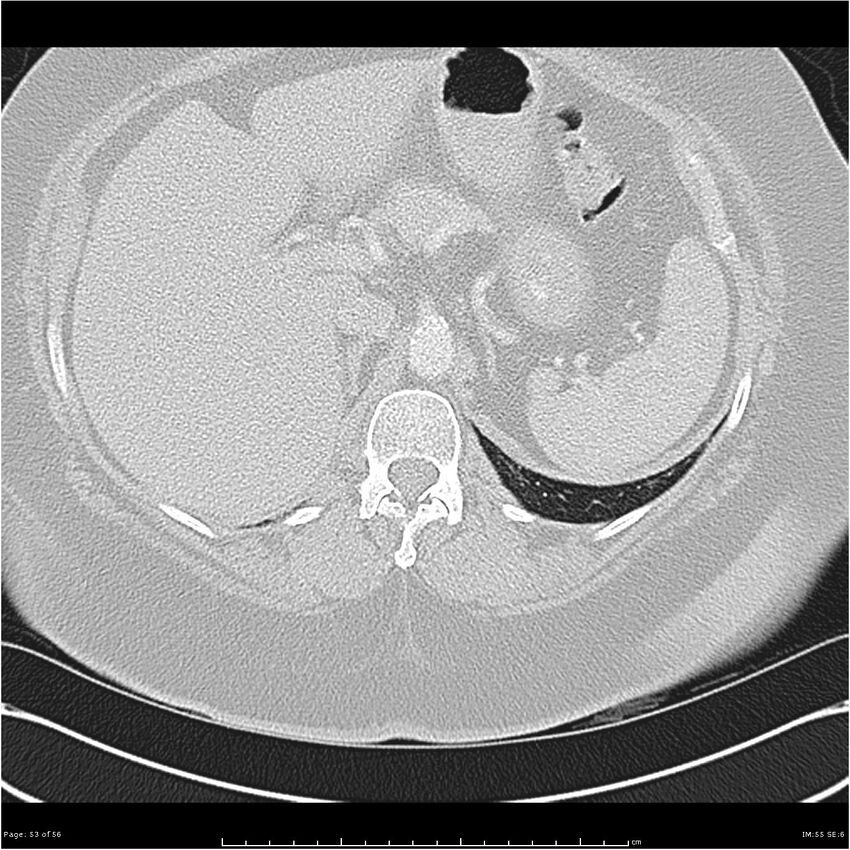 Benign metastasizing leiomyoma (Radiopaedia 26803-26962 Axial lung window 53).jpg