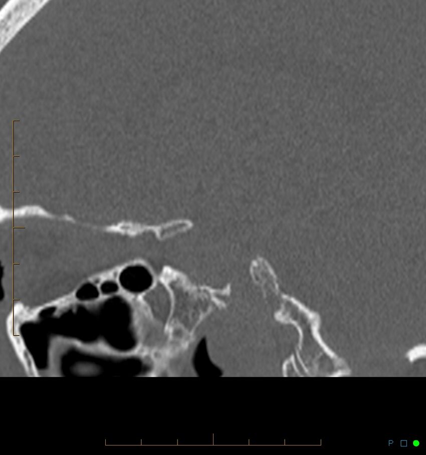 Benign notochordal cell tumor (probable) (Radiopaedia 65475-74546 Sagittal bone window 5).jpg