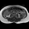 Bicornuate uterus (Radiopaedia 61974-70046 Axial T1 5).jpg