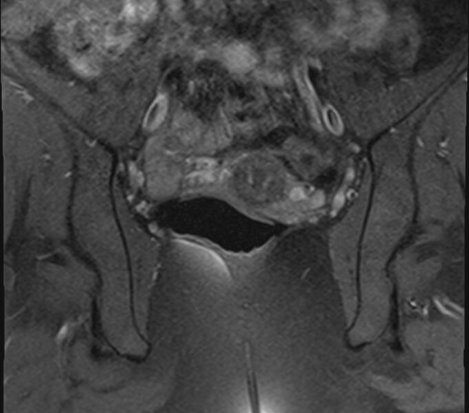File:Bicornuate uterus (Radiopaedia 71214-81511 Coronal T1 fat sat 15).jpg