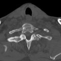 Bilateral C6-7 locked facet dislocation (Radiopaedia 28506-28748 Axial bone window 35).jpeg