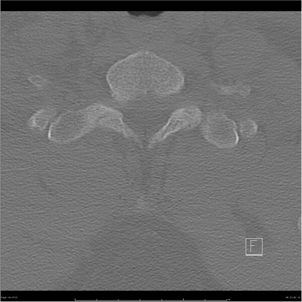 File:Bilateral cervical ribs (Radiopaedia 25868-26017 Axial bone window 45).jpg