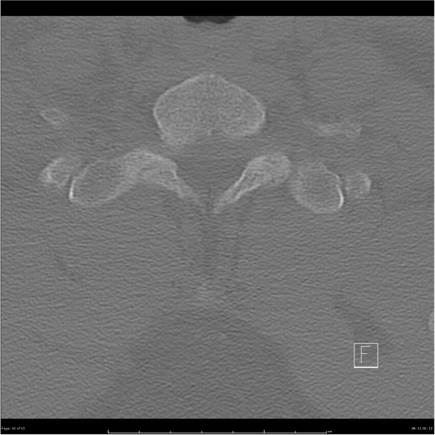 Bilateral cervical ribs (Radiopaedia 25868-26017 Axial bone window 45).jpg