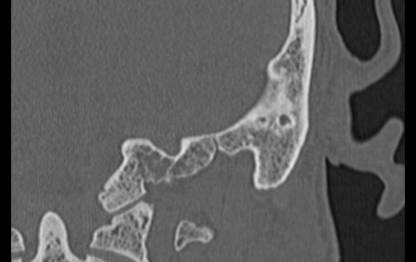 Bilateral cholesteatoma (Radiopaedia 54898-61172 D 60).jpg