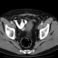 Bilateral direct inguinal herniae (Radiopaedia 17016-16719 B 12).jpg