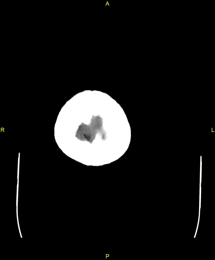 Bilateral isodense subdural hematomas (Radiopaedia 88621-105325 Axial non-contrast 106).jpg