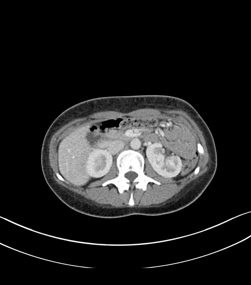 Bilateral kidney malrotation (Radiopaedia 72227-82749 A 19).jpg