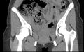 Bilateral mature cystic ovarian teratoma (Radiopaedia 88821-105592 Coronal non-contrast 3).jpg