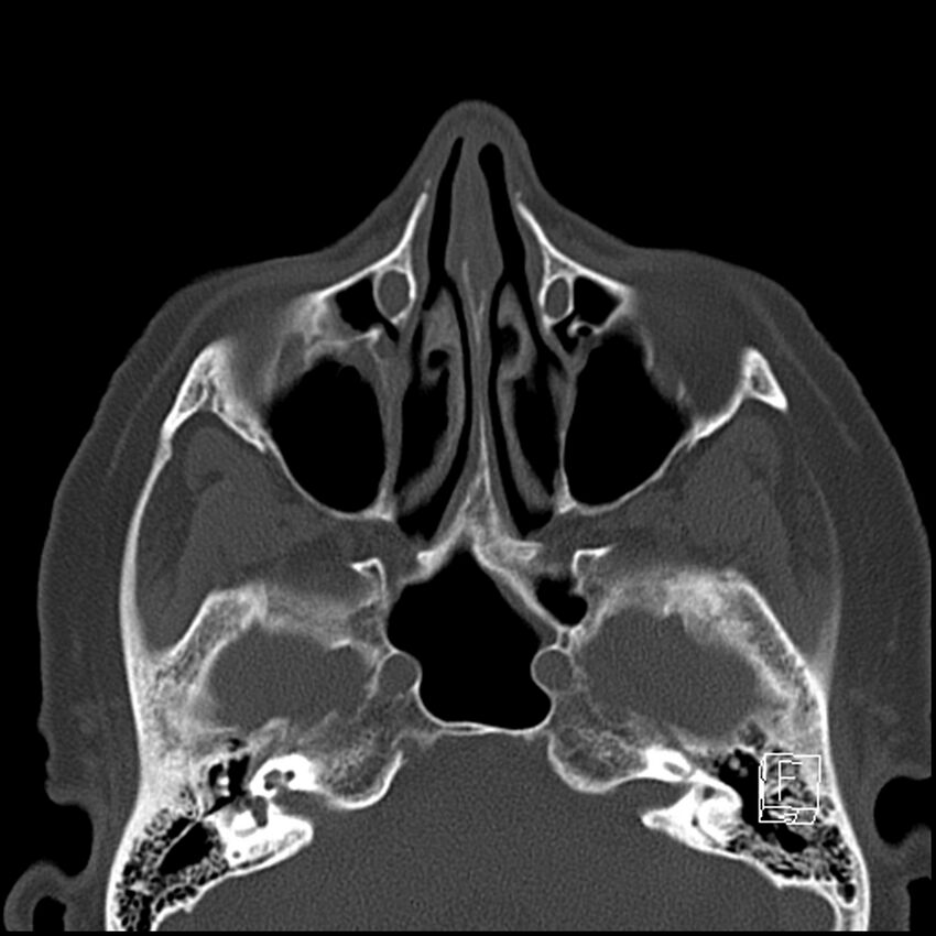 Bilateral palatine tonsilloliths on OPG and CT (Radiopaedia 75167-86247 Axial bone window 16).jpg
