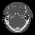 Bilateral perched facets with cord injury (Radiopaedia 45587-49713 Axial bone window 15).jpg