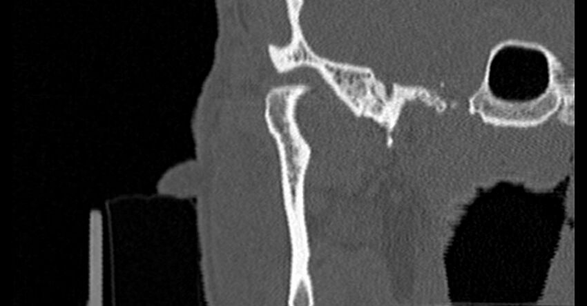 Bilateral temporal bone fractures (Radiopaedia 29482-29970 Coronal non-contrast 35).jpg