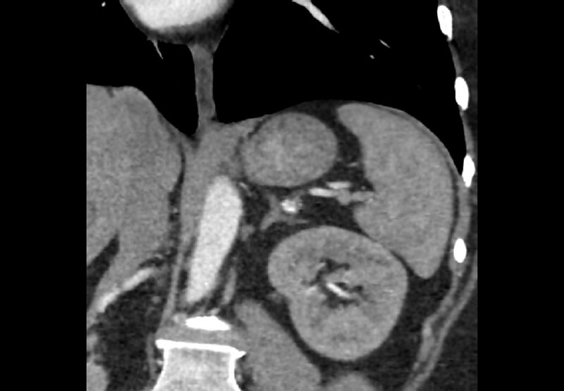 File:Bilateral urolithiasis with incidentally detected splenic artery aneurysm and left inferior vena cava (Radiopaedia 44467-48127 Ob. Cor. C+ Art. 4).jpg