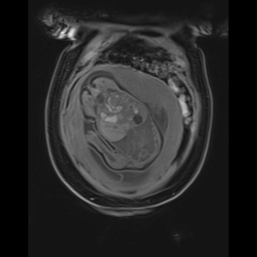 Bilobed placenta accreta (Radiopaedia 69648-79591 Coronal T1 vibe 37).jpg