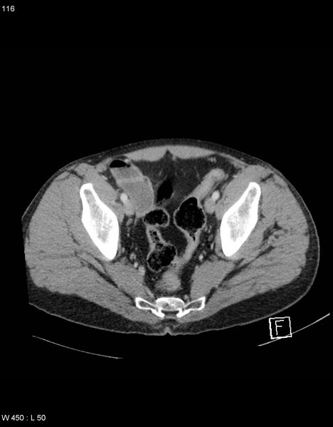 File:Boerhaave syndrome with tension pneumothorax (Radiopaedia 56794-63603 A 58).jpg
