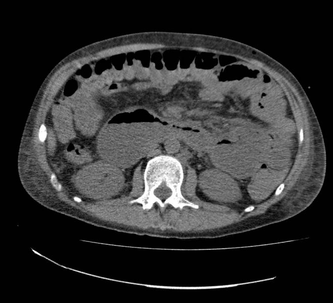 File:Bowel lymphoma complicated by bleeding after therapy (Radiopaedia 55601-62110 Axial non-contrast 36).jpg