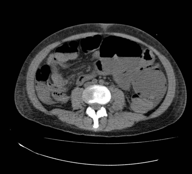 File:Bowel lymphoma complicated by bleeding after therapy (Radiopaedia 55601-62110 Axial non-contrast 47).jpg
