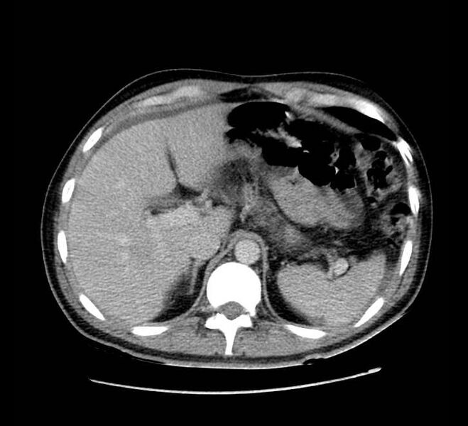 File:Bowel obstruction from colon carcinoma (Radiopaedia 22995-23028 A 18).jpg