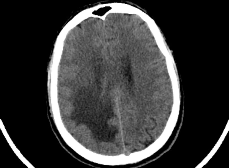 File:Brain abscess complicated by intraventricular rupture and ventriculitis (Radiopaedia 82434-96575 Axial non-contrast 76).jpg