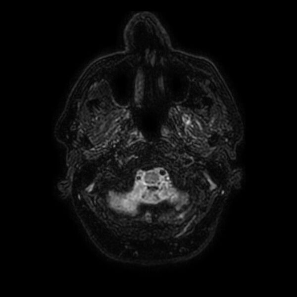 File:Brain abscess complicated by intraventricular rupture and ventriculitis (Radiopaedia 82434-96577 Axial FLAIR 1).jpg