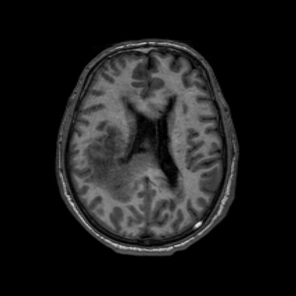 File:Brain abscess complicated by intraventricular rupture and ventriculitis (Radiopaedia 82434-96577 Axial T1 42).jpg