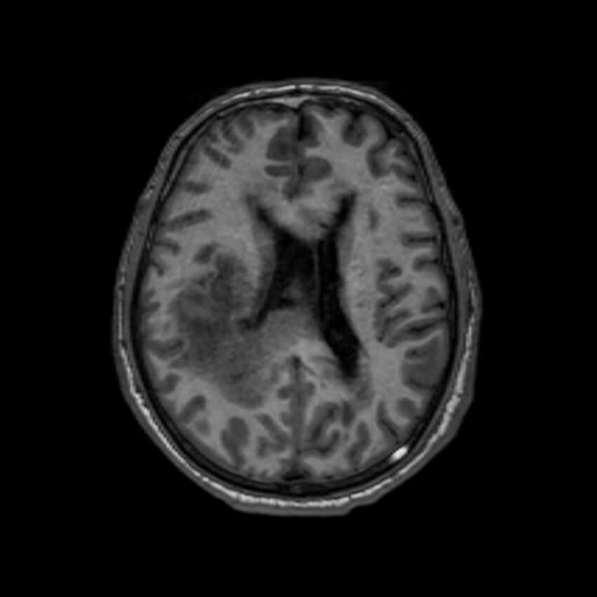 Brain abscess complicated by intraventricular rupture and ventriculitis (Radiopaedia 82434-96577 Axial T1 42).jpg