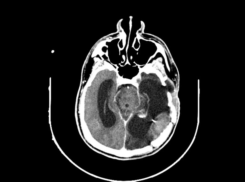 Brain injury by firearm projectile (Radiopaedia 82068-96088 B 109).jpg