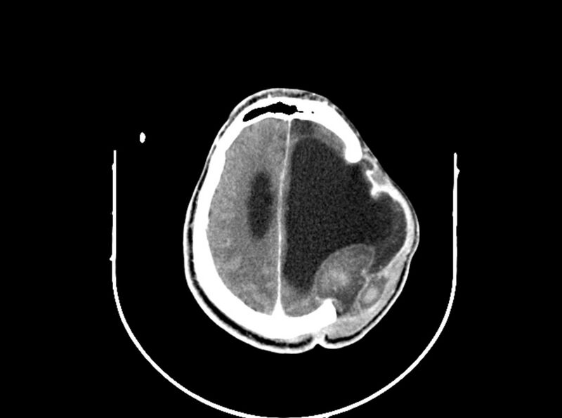File:Brain injury by firearm projectile (Radiopaedia 82068-96088 B 165).jpg