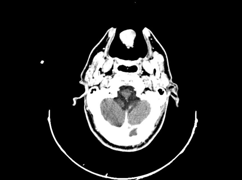 Brain injury by firearm projectile (Radiopaedia 82068-96088 B 64).jpg