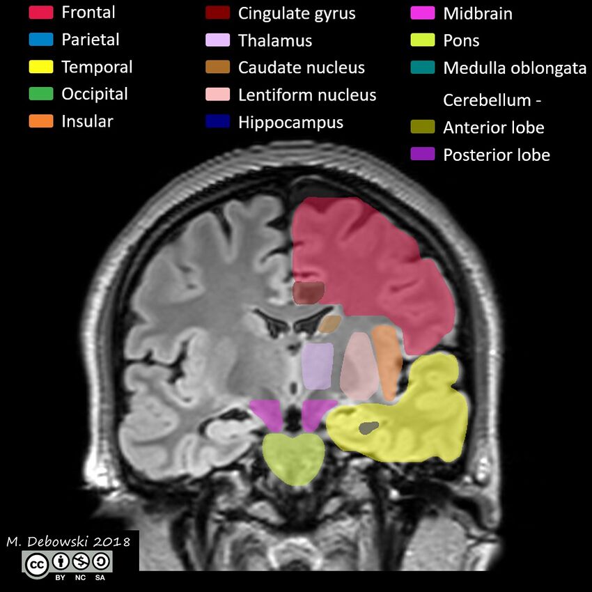 Brain lobes - annotated MRI (Radiopaedia 61691-69700 Coronal 34).JPG