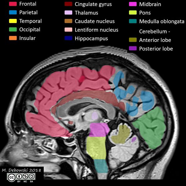 File:Brain lobes - annotated MRI (Radiopaedia 61691-69700 Sagittal 40).JPG